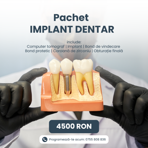 2 implant dentar